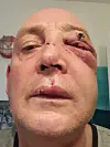 Sebastian F. (Name geändert) nach dem Angriff. Das Foto schickte er der MOPO aus dem Krankenhaus.